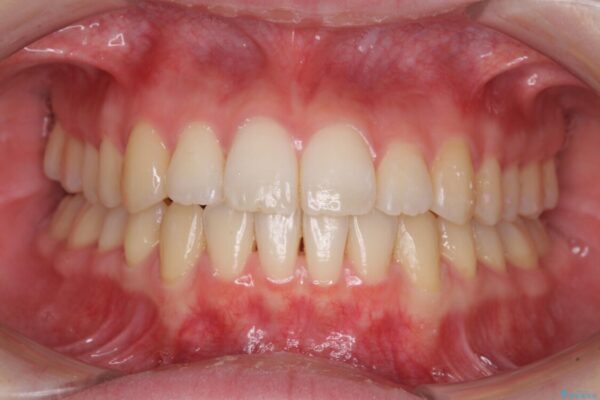 前歯の微妙なガタつきが気になる　インビザライン・ライトでの矯正治療 治療後画像
