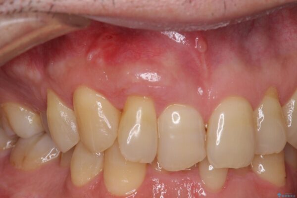 歯根が露出している歯の歯肉移植　根面被覆術 アフター