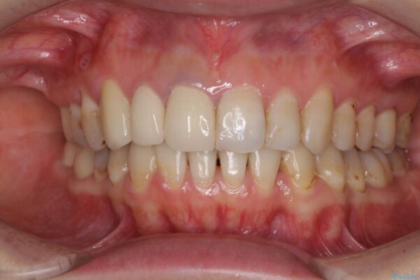 歯並びと目立つ金属を治したい　総合歯科治療 アフター