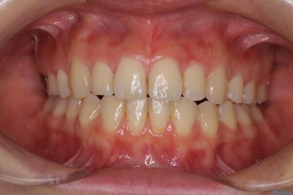 前歯2本が欠損　抜歯矯正でデコボコを治す 治療後画像