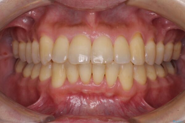 前歯のデコボコ　ワイヤー装置での短期間治療 治療後画像