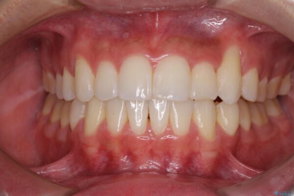 八重歯と奥歯のクロスバイト　上顎骨を拡大してインビザラインで矯正 アフター