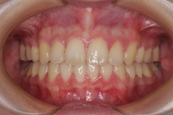 費用を抑えた抜歯矯正　口元の突出感の改善 治療後画像