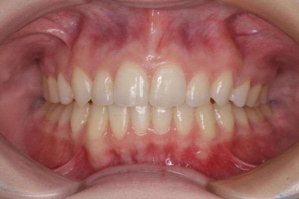 八重歯を短期間で改善　ワイヤー装置による抜歯矯正 治療後画像