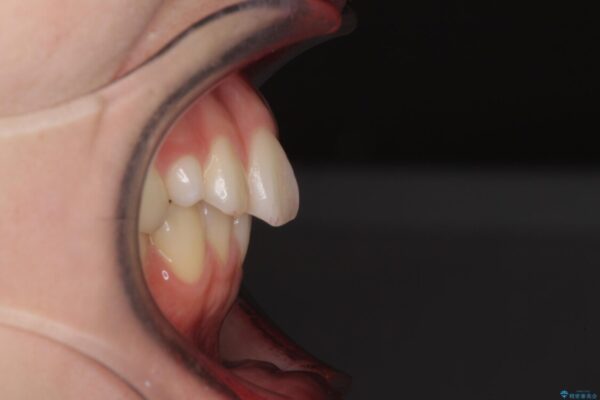狭い上顎骨を拡大　急速拡大装置を併用したインビザライン矯正 治療前画像