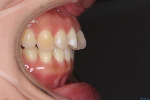 軽度な歯列不正　インビザライン・ライトによる矯正治療 治療前画像