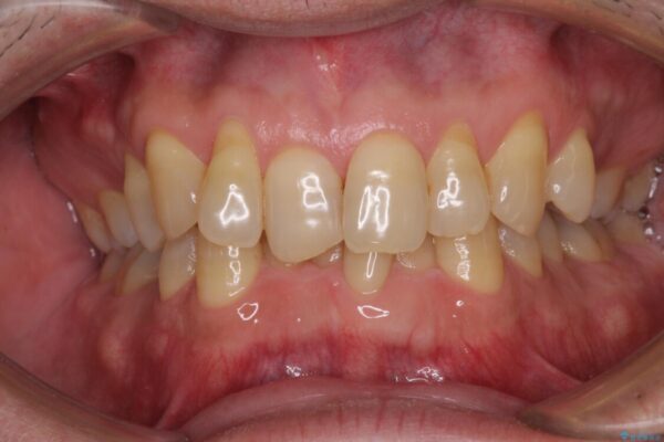 歯根が露出している歯の歯肉移植　根面被覆術 治療前画像