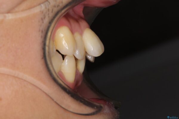 前歯のデコボコ　ワイヤー装置での短期間治療 治療前画像