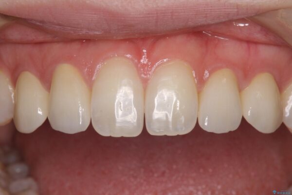 前歯の奇形歯　オールセラミッククラウンによる審美歯科治療 治療後画像