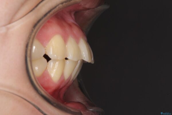 部分矯正で出っ歯になってしまった　出っ歯改善の抜歯矯正 治療前画像