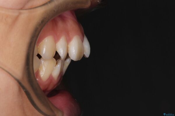 スッキリとした口元へ　出っ歯の抜歯矯正 治療前画像