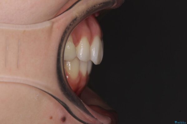 狭い上顎骨を拡大　急速拡大装置を併用したインビザライン矯正 治療後画像