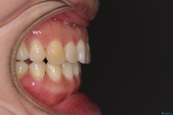 軽度な歯列不正　インビザライン・ライトによる矯正治療 治療後画像