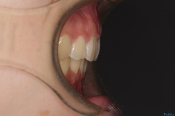 部分矯正で出っ歯になってしまった　出っ歯改善の抜歯矯正 治療後画像