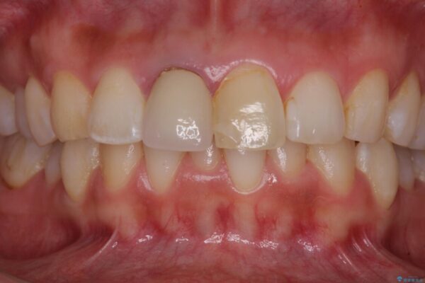 目立つ前歯の詰め物　オーダーメイドのセラミッククラウンで審美的に仕上げる 治療前画像