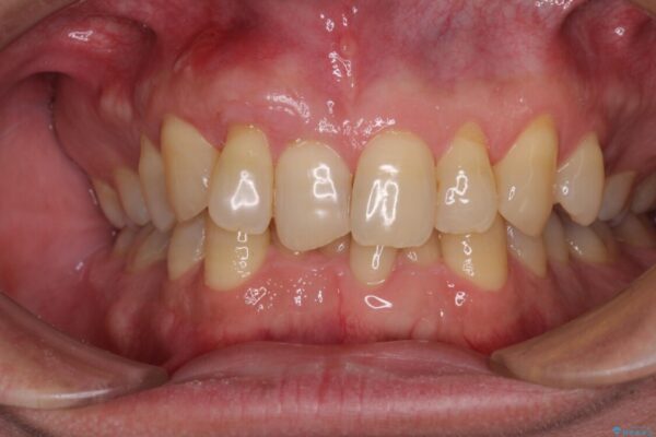 歯根が露出している歯の歯肉移植　根面被覆術 治療後画像