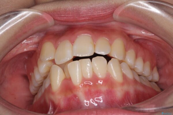 前歯の正中のズレを改善　目立たないワイヤー装置での抜歯矯正 治療前画像