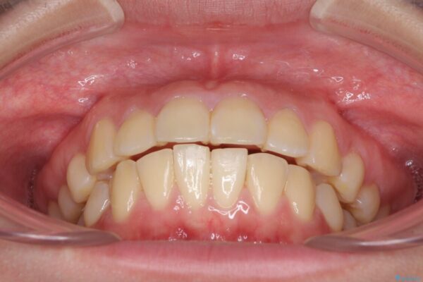 部分矯正で出っ歯になってしまった　出っ歯改善の抜歯矯正 治療前画像