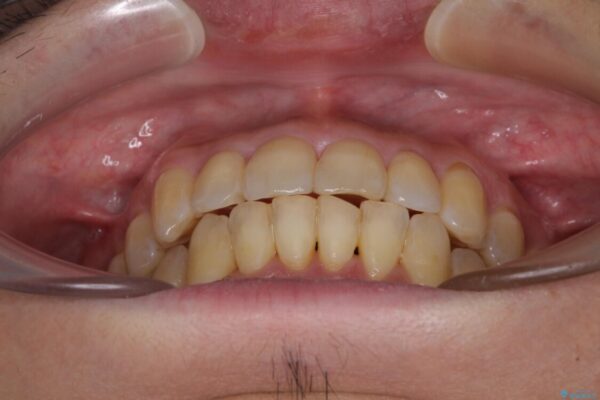 前歯のデコボコ　ワイヤー装置での短期間治療 治療後画像