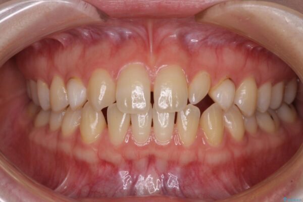 前歯の奇形歯　オールセラミッククラウンによる審美歯科治療 治療前画像