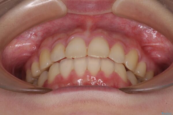 費用を抑えた抜歯矯正　口元の突出感の改善 治療後画像
