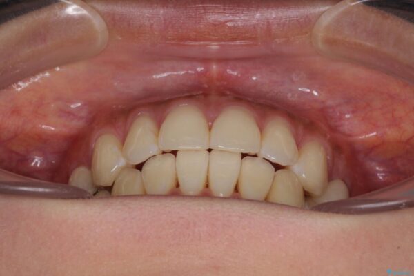 八重歯の再矯正　インビザラインでストレスなく矯正治療 治療後画像