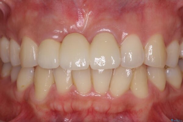 治療途中で放置した前歯　オールセラミックブリッジ 治療後画像