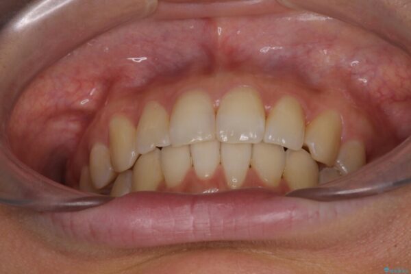 インビザラインによる矯正治療　カリエールディスタライザーを用いた奥歯の咬み合わせ改善 治療後画像