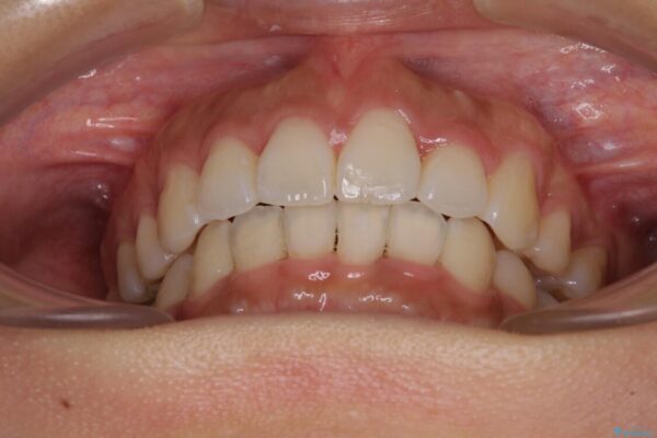 スッキリとした口元へ　出っ歯の抜歯矯正 治療後画像