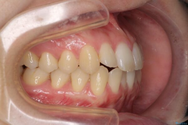 前歯の微妙なガタつきが気になる　インビザライン・ライトでの矯正治療 治療前画像