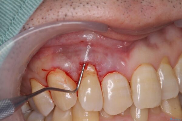 歯根が露出している歯の歯肉移植　根面被覆術 治療途中画像
