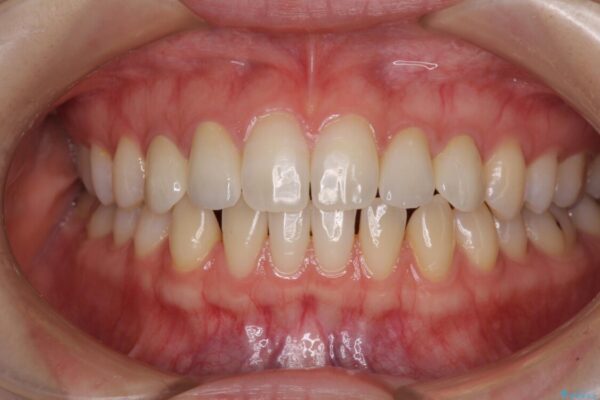 前歯の奇形歯　オールセラミッククラウンによる審美歯科治療 治療後画像