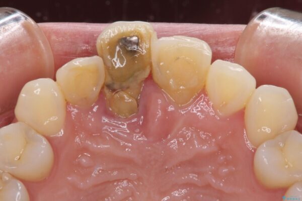 治療途中で放置した前歯　オールセラミックブリッジ 治療前画像