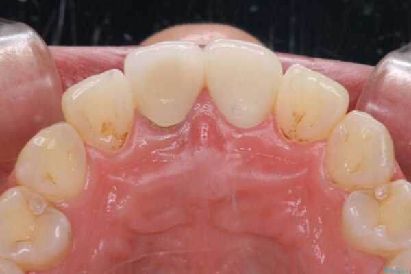 目立つ前歯の詰め物　オーダーメイドのセラミッククラウンで審美的に仕上げる 治療後画像