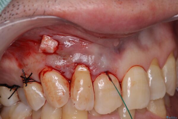歯根が露出している歯の歯肉移植　根面被覆術 治療後画像