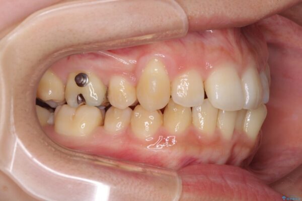 八重歯の抜歯矯正　補助装置を用いたインビザライン矯正 治療途中画像
