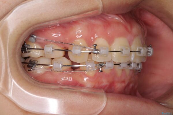 部分矯正で出っ歯になってしまった　出っ歯改善の抜歯矯正 治療途中画像