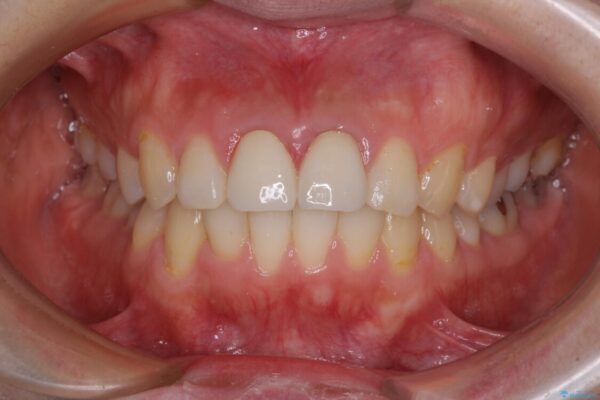 変色した前歯のクラウン　オールセラミッククラウンにより審美歯科治療 治療後画像