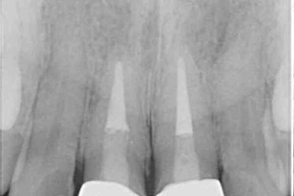 変色した前歯のクラウン　オールセラミッククラウンにより審美歯科治療 治療後画像