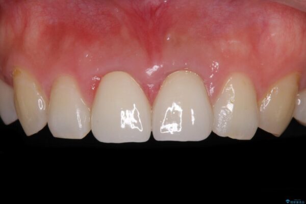 変色した前歯のクラウン　オールセラミッククラウンにより審美歯科治療 アフター