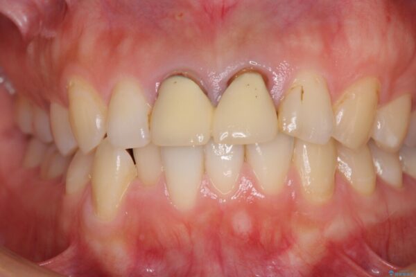 変色した前歯のクラウン　オールセラミッククラウンにより審美歯科治療 治療前画像