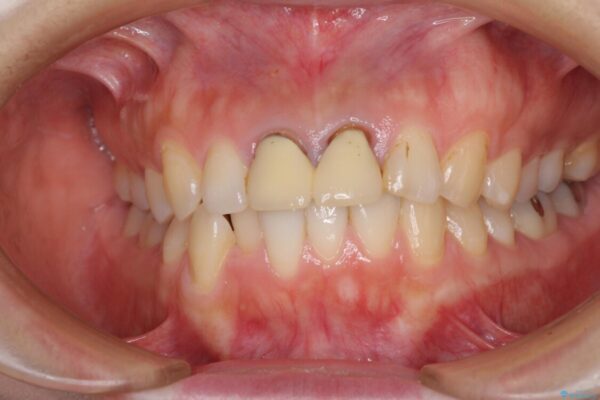 変色した前歯のクラウン　オールセラミッククラウンにより審美歯科治療 治療前画像