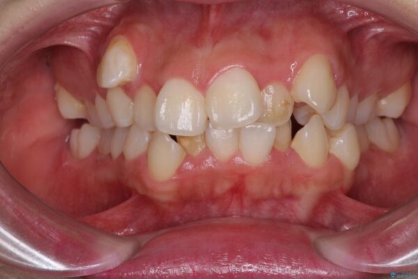 著しい叢生と顎骨のズレ　ワイヤー装置による抜歯矯正 ビフォー