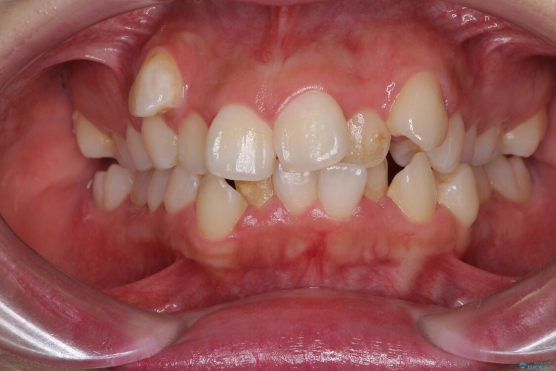 著しい叢生と顎骨のズレ　ワイヤー装置による抜歯矯正 治療前