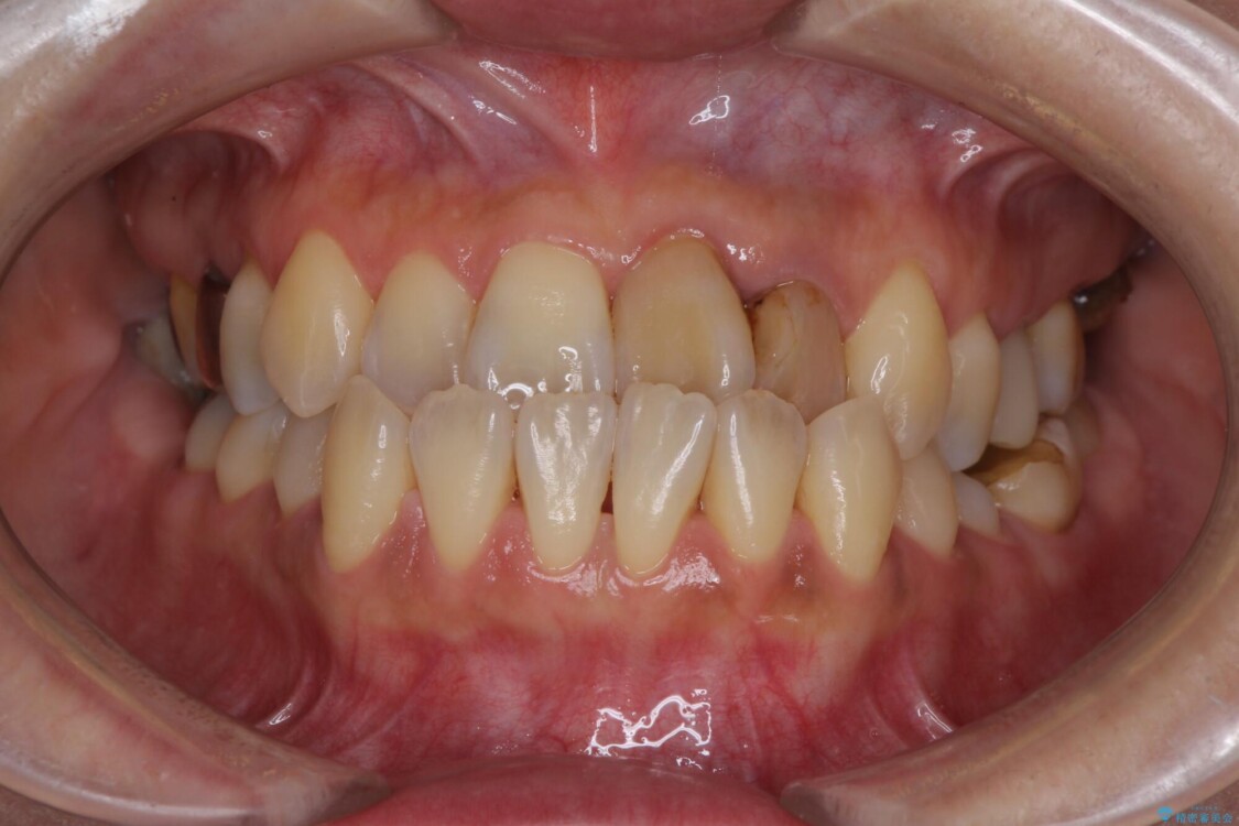 反対咬合で痛む前歯を改善　インビザラインによる矯正治療 ビフォー
