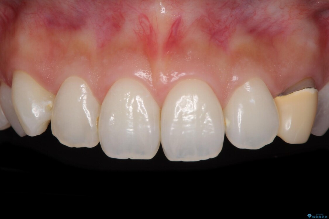 保険診療の変色したクラウン　前歯の審美歯科治療 治療前