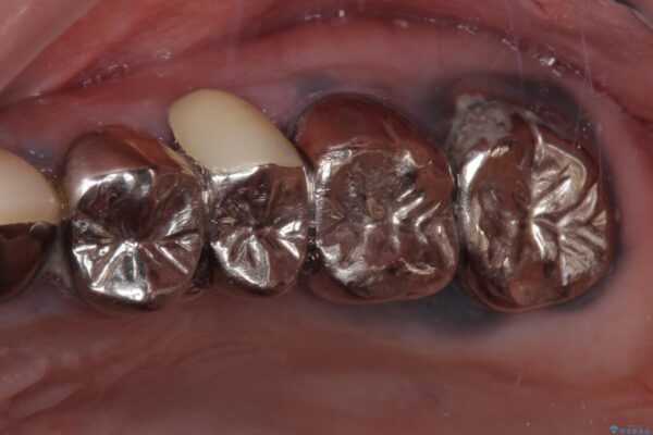目立つ銀色の奥歯をセラミックに　セラミックブリッジ 治療前画像