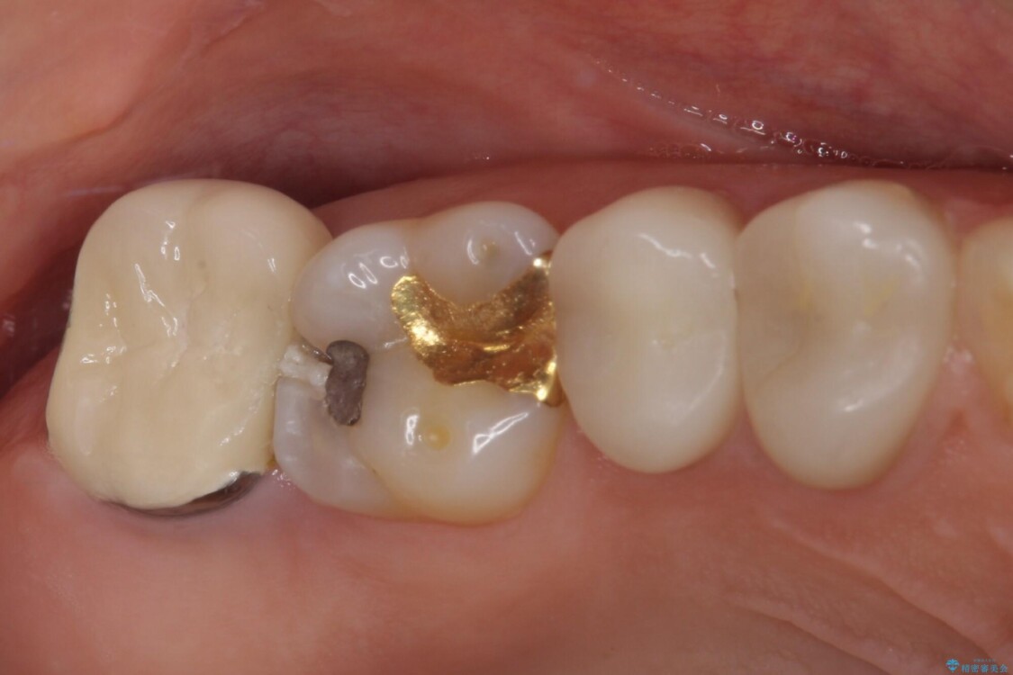強い咬み合わせでむし歯が悪化　ゴールドインレーによるむし歯治療 治療前