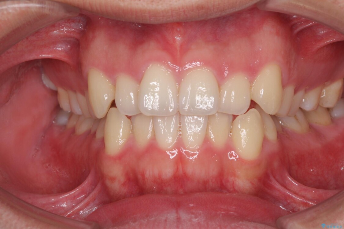 狭い歯列と前歯のデコボコ　インビザラインによる矯正治療 治療前