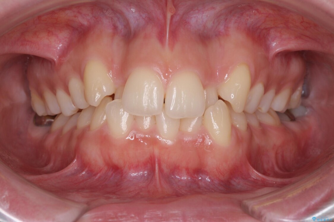 骨格的に左右にずれいている　前歯のデコボコをインビザラインで解消 治療前